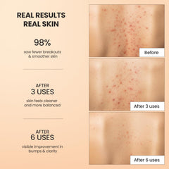 BellamiLuxx exfoliante cuerpo acne aplicación manual en ducha
