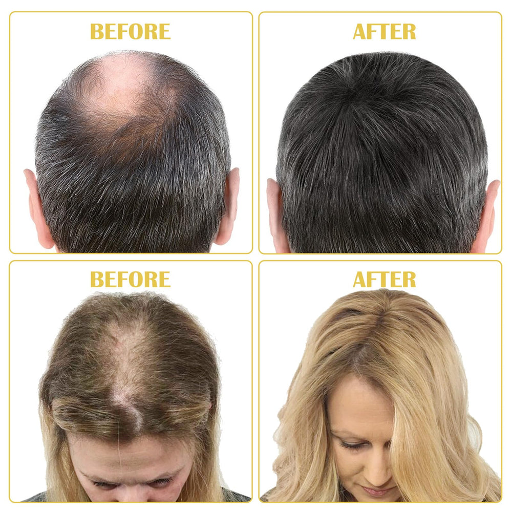 Bieyoc Minoxidil Sérum: puede aumentar la densidad para un cabello más robusto.