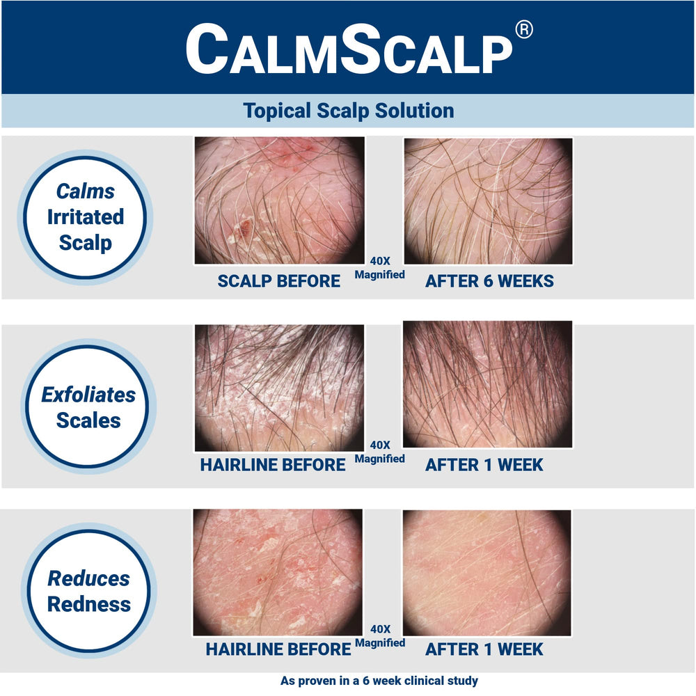 CalmScalp aplicación rápida para la línea del cabello con picor