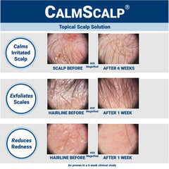 CalmScalp aplicación rápida para la línea del cabello con picor