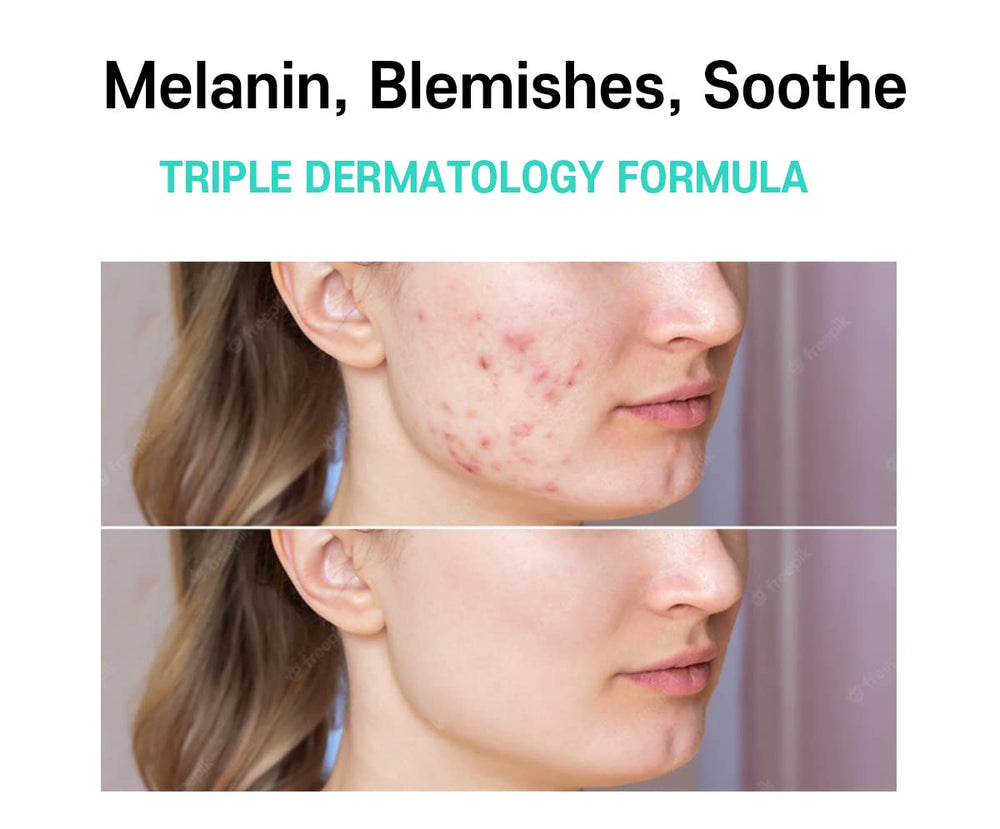 CARE:NEL Crema Melasma, destello de manchas: apoyo para tono parejo.