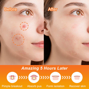 Celecare parches acne Halloween telaranas, cobertura rápida en zonas problemáticas.