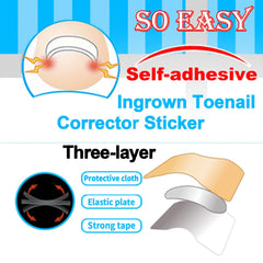 Chemailon parche corrector de uñas curvas, ajusta suavemente la forma de la uña.