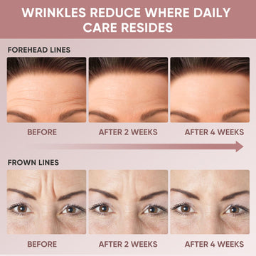 Chialing Forehead Wrinkle Patches apply overnight for restful skin care.