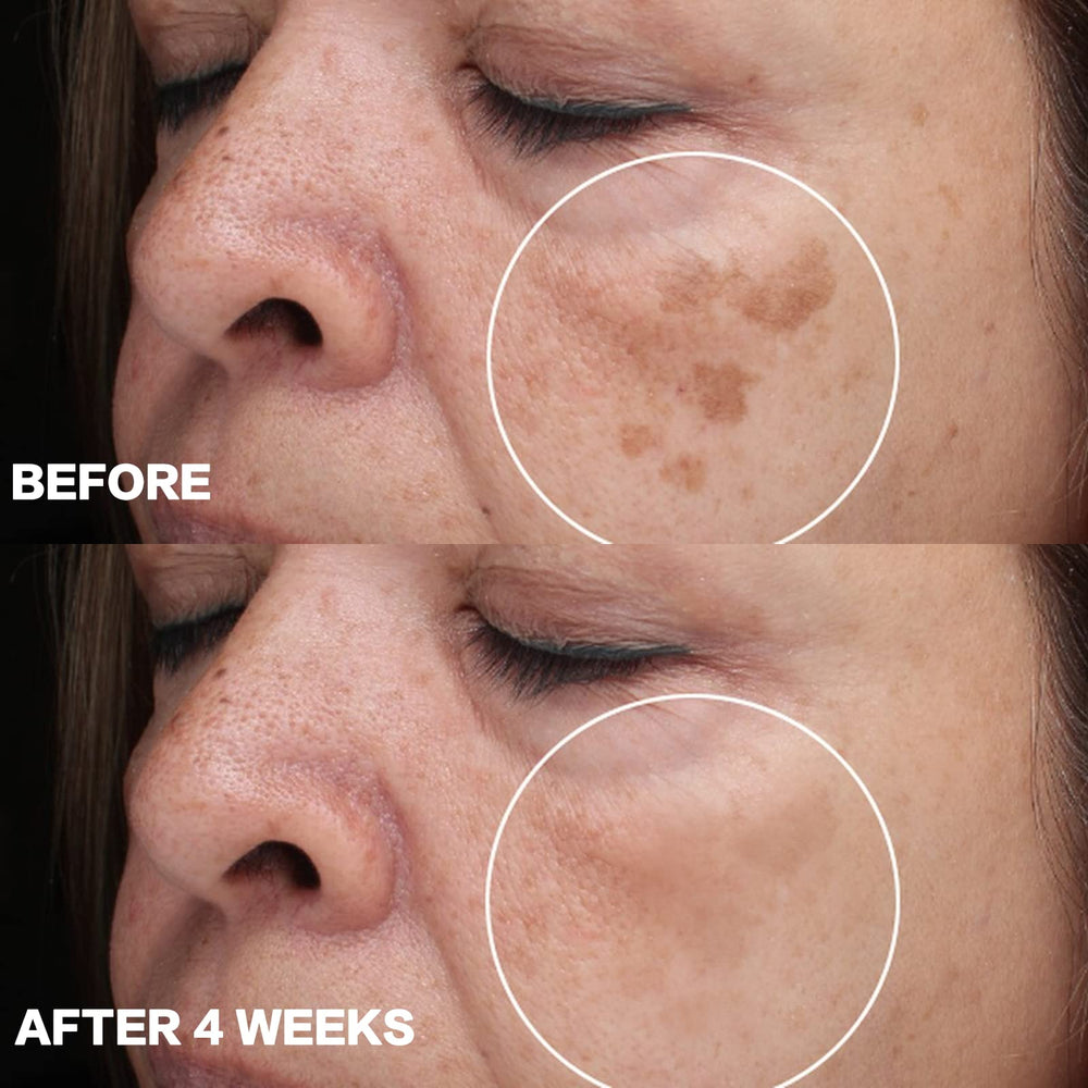 CITYGOO combate varias manchas: melasma, manchas solares y de acné.