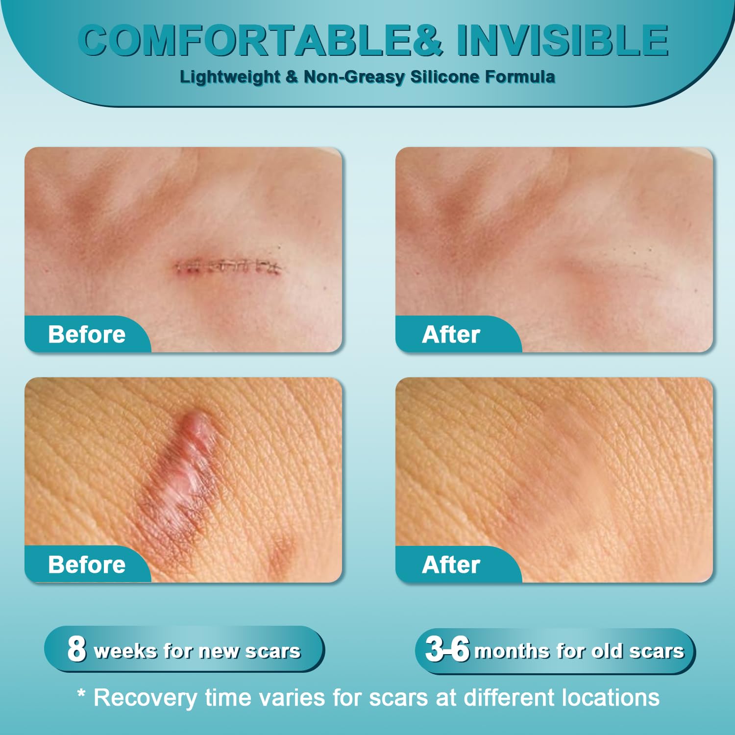 ClearPiny crema cicatrices, tratamiento versátil para cara y cuerpo, reduce enrojecimiento.