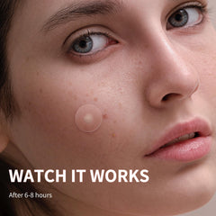 Daolyo parches acne 14mm para zonas más grandes