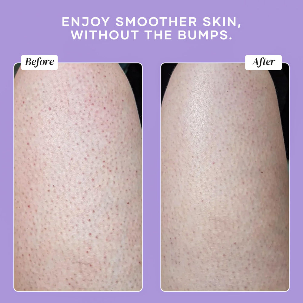 DERMAdoctor KP Bump Eraser, uso en piernas, piel más suave.