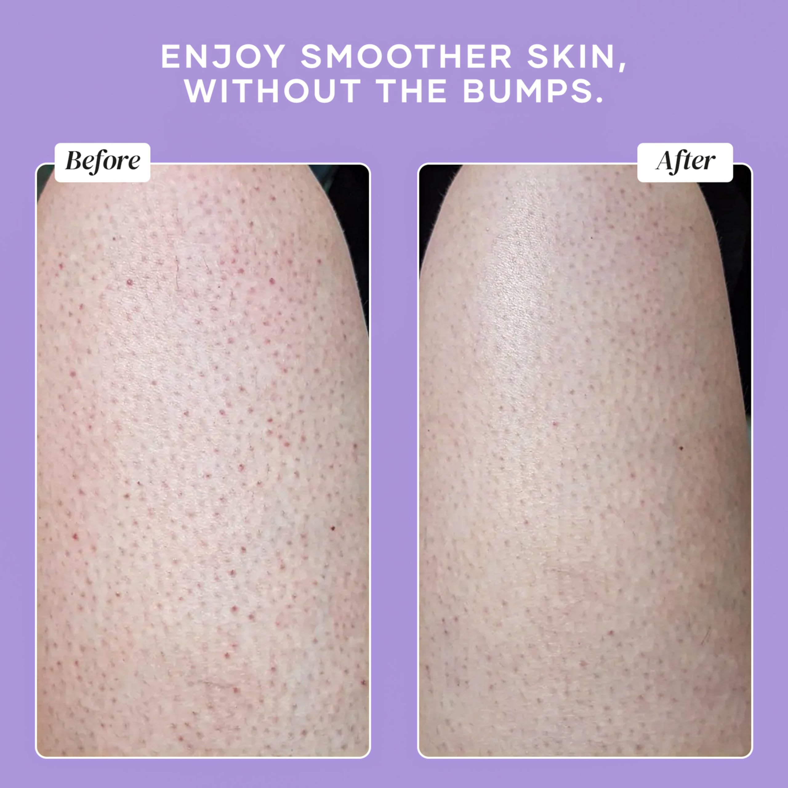 DERMAdoctor KP Bump Eraser favorece textura uniforme de la piel.