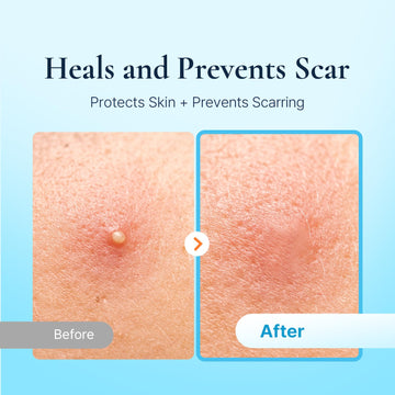 DERMAKR parche acne resistente al agua protege durante el dia