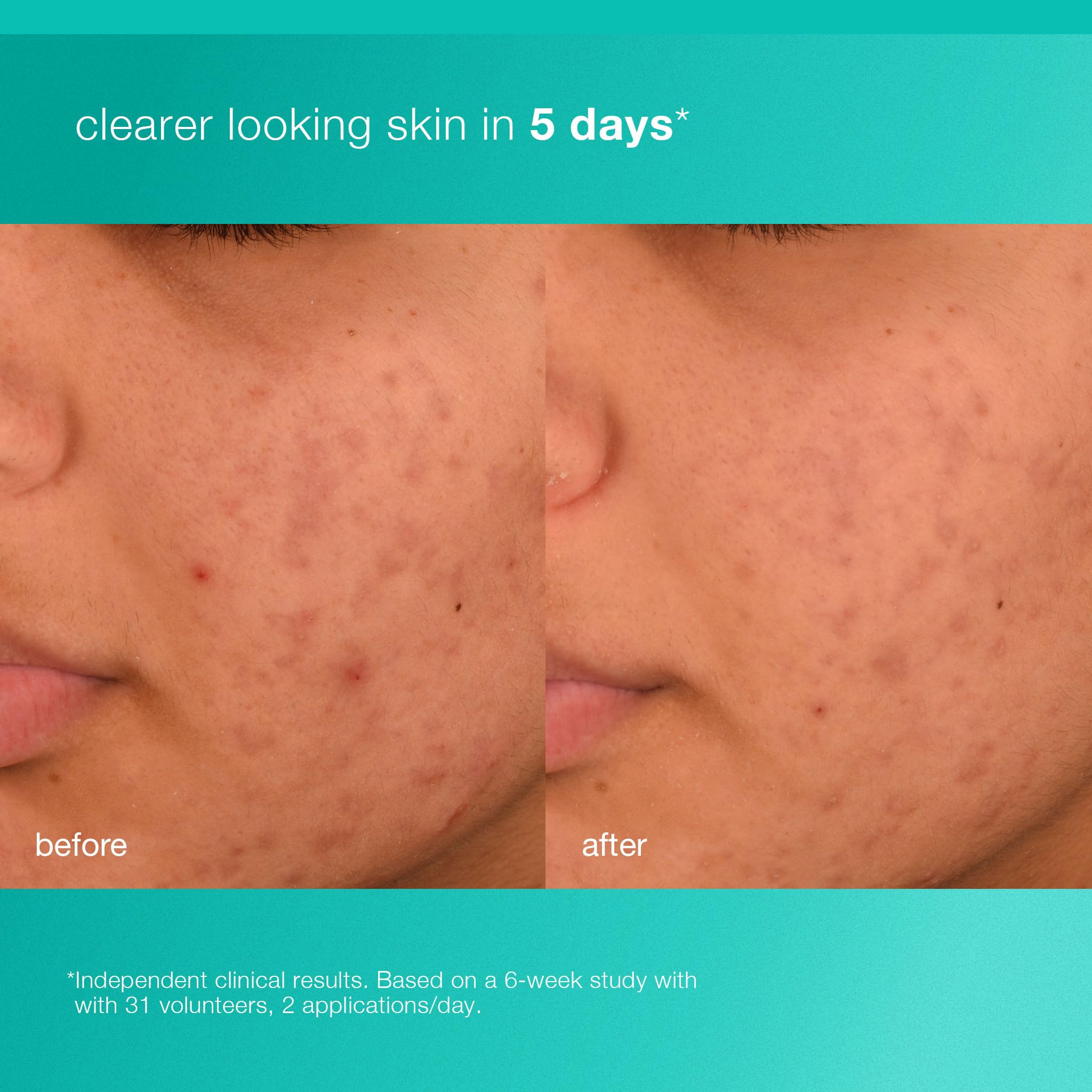 Dermalogica Acne Biotic: ácido salicílico al 0,5% para poros más limpios.