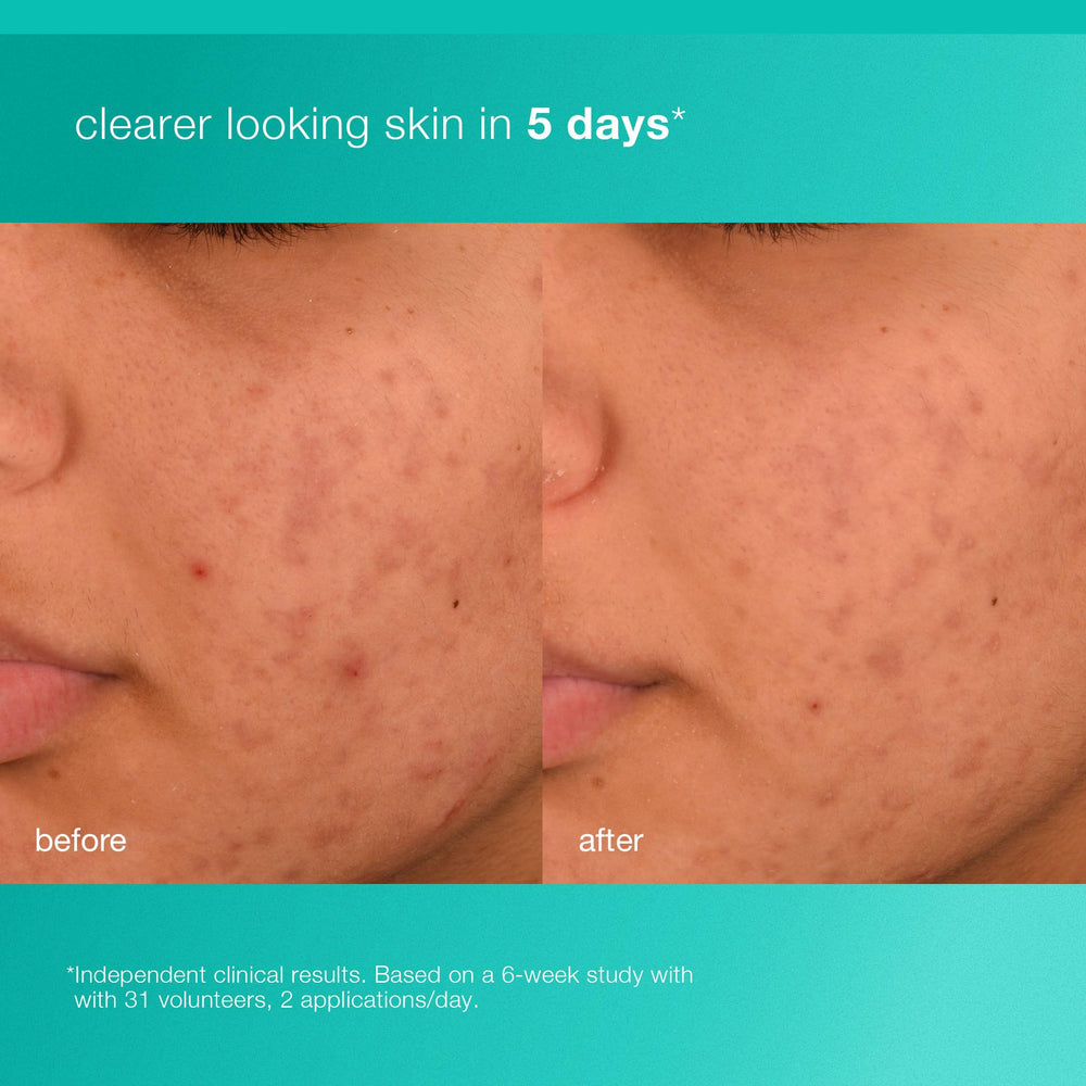 Dermalogica Acne Biotic: ácido salicílico al 0,5% para poros más limpios.