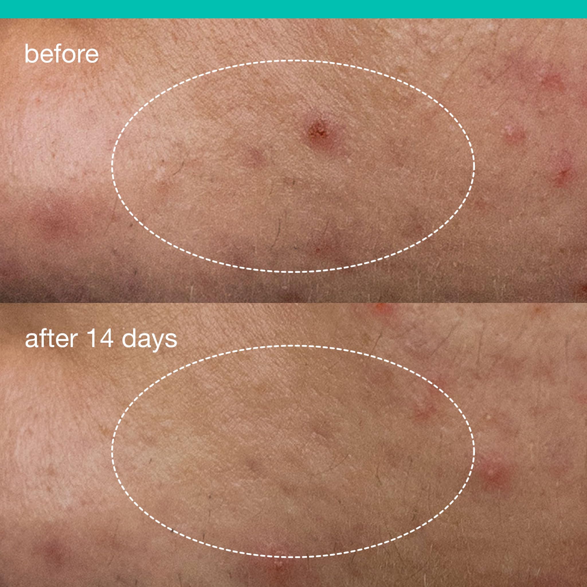 Dermalogica Parche líquido para acné reduce el exceso de grasa.