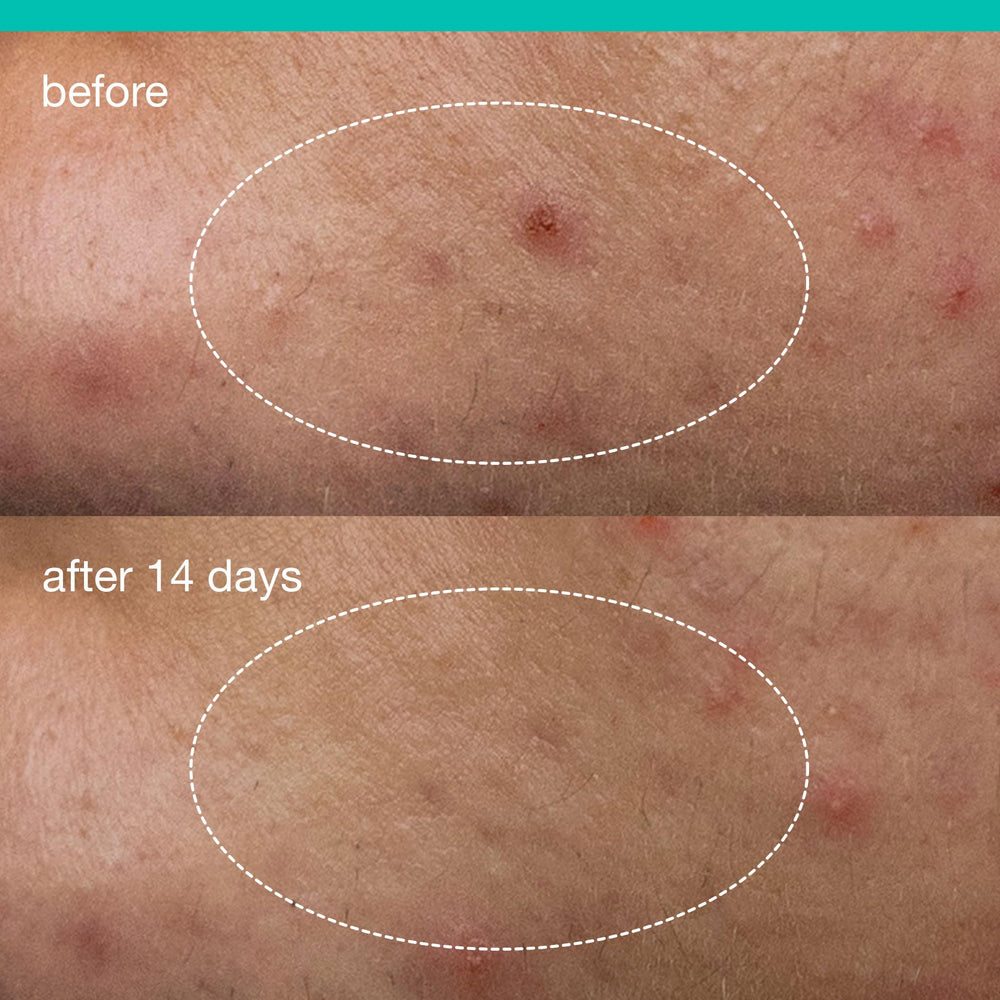 Dermalogica Parche líquido para acné reduce el exceso de grasa.