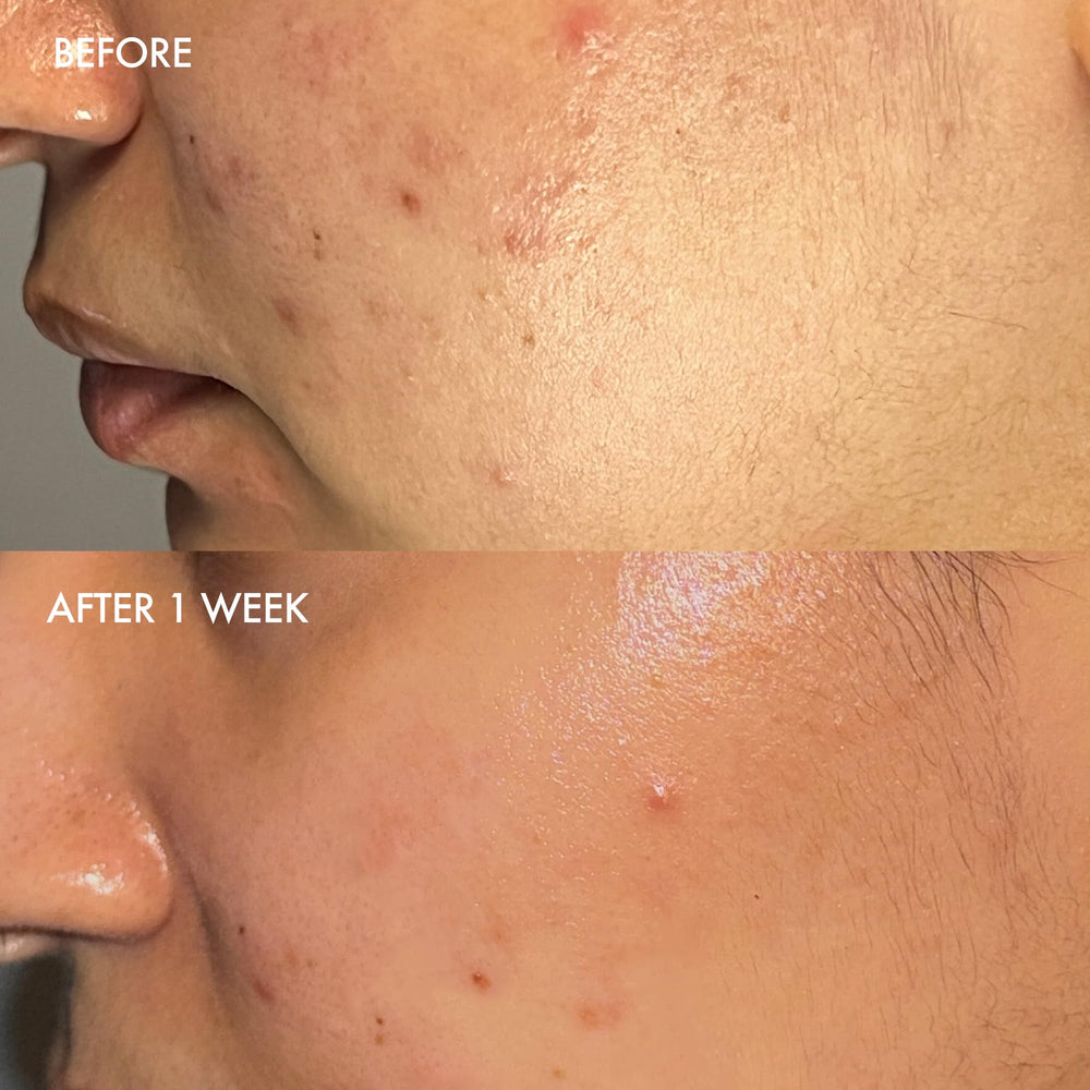 Dermisa barra exfoliante suave, aloe vera para una piel clara