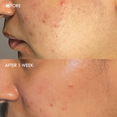 Dermisa barra exfoliante suave, aloe vera para una piel clara