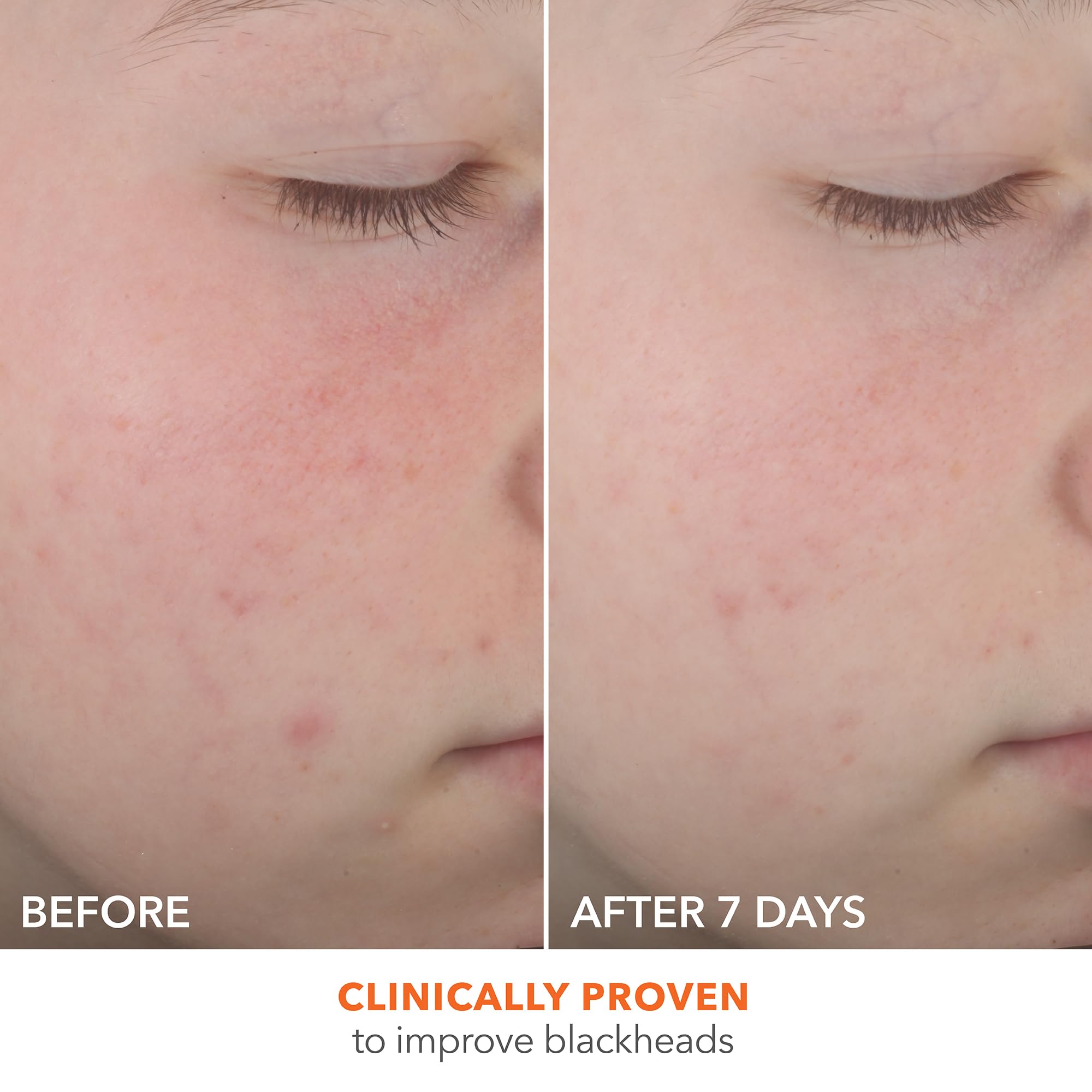 Ingredients label highlights 2% salicylic and glycolic acids for targeted blemish care.