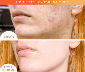Dr Dennis Gross Alpha Beta Universal Daily Peel: poros refinados para una piel más limpia