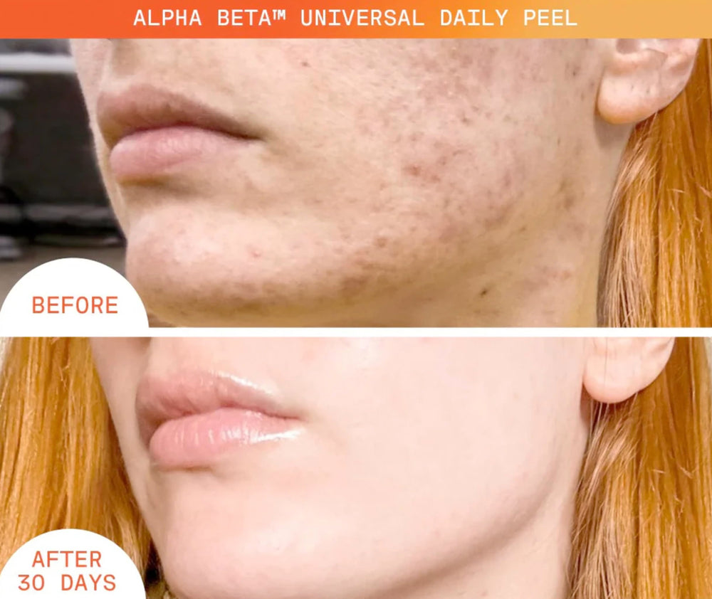 Dr Dennis Gross Alpha Beta Universal Daily Peel: poros refinados para una piel más limpia