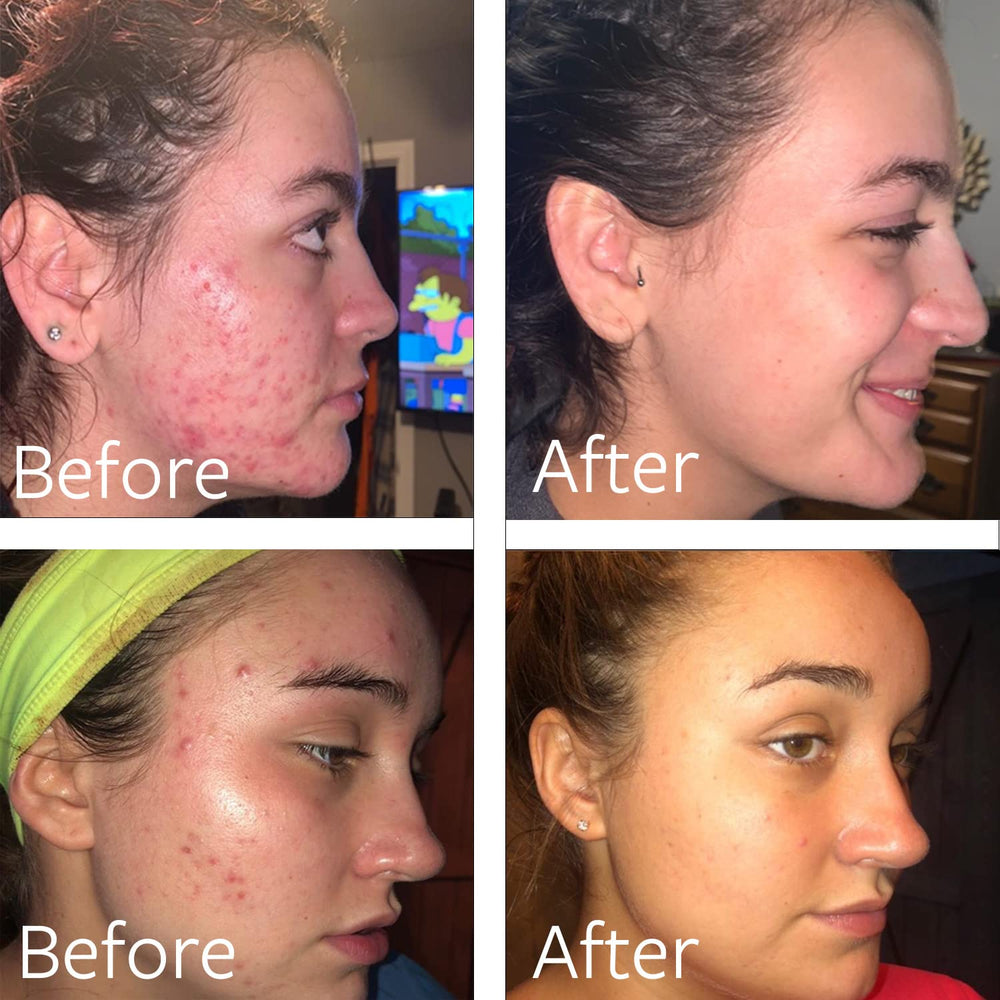 Dr Song Benzoyl Peroxide Wash: texture moussante qui nettoie sans dessécher la peau.