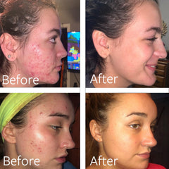 Dr Song Benzoyl Peroxide Wash: texture moussante qui nettoie sans dessécher la peau.
