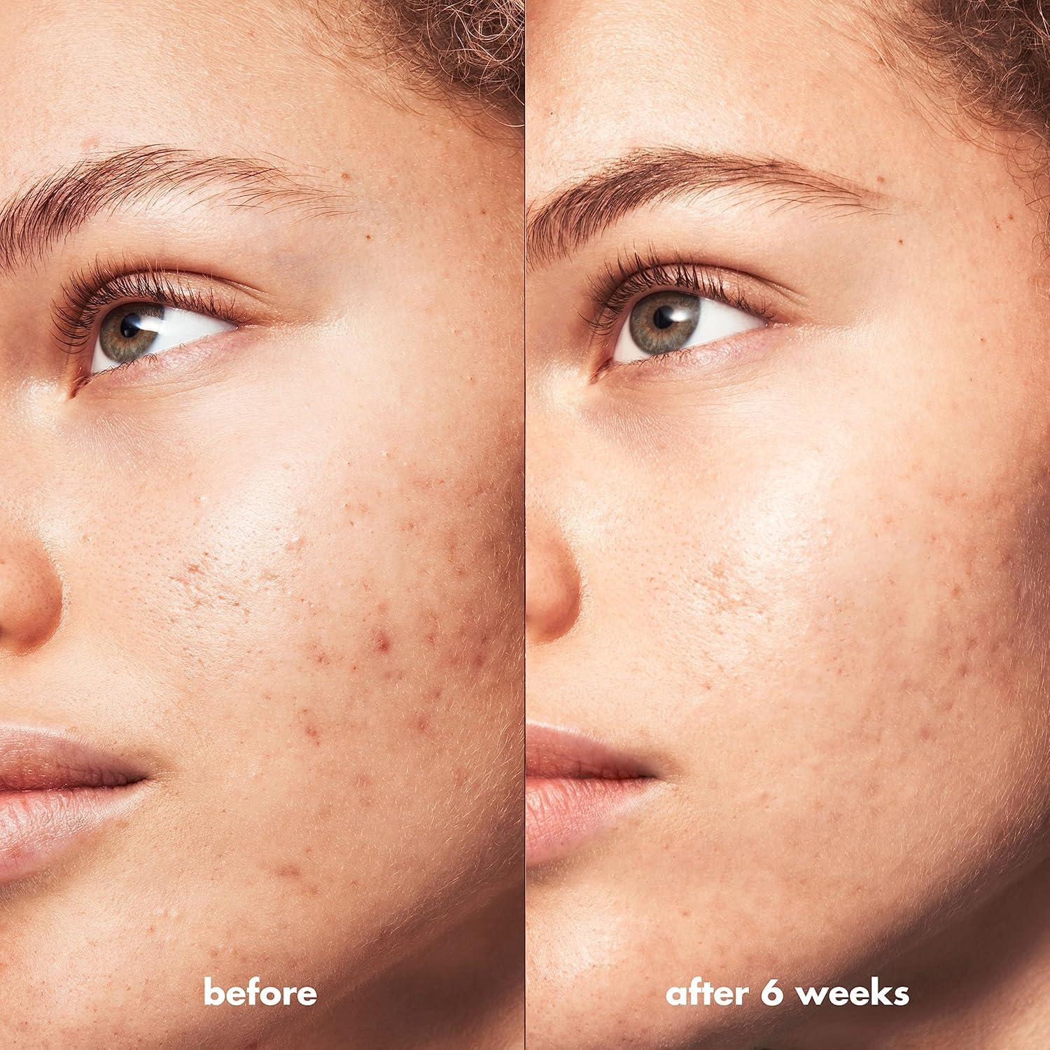e.l.f. SKIN Blemish Breakthrough: complejo ácido triple.