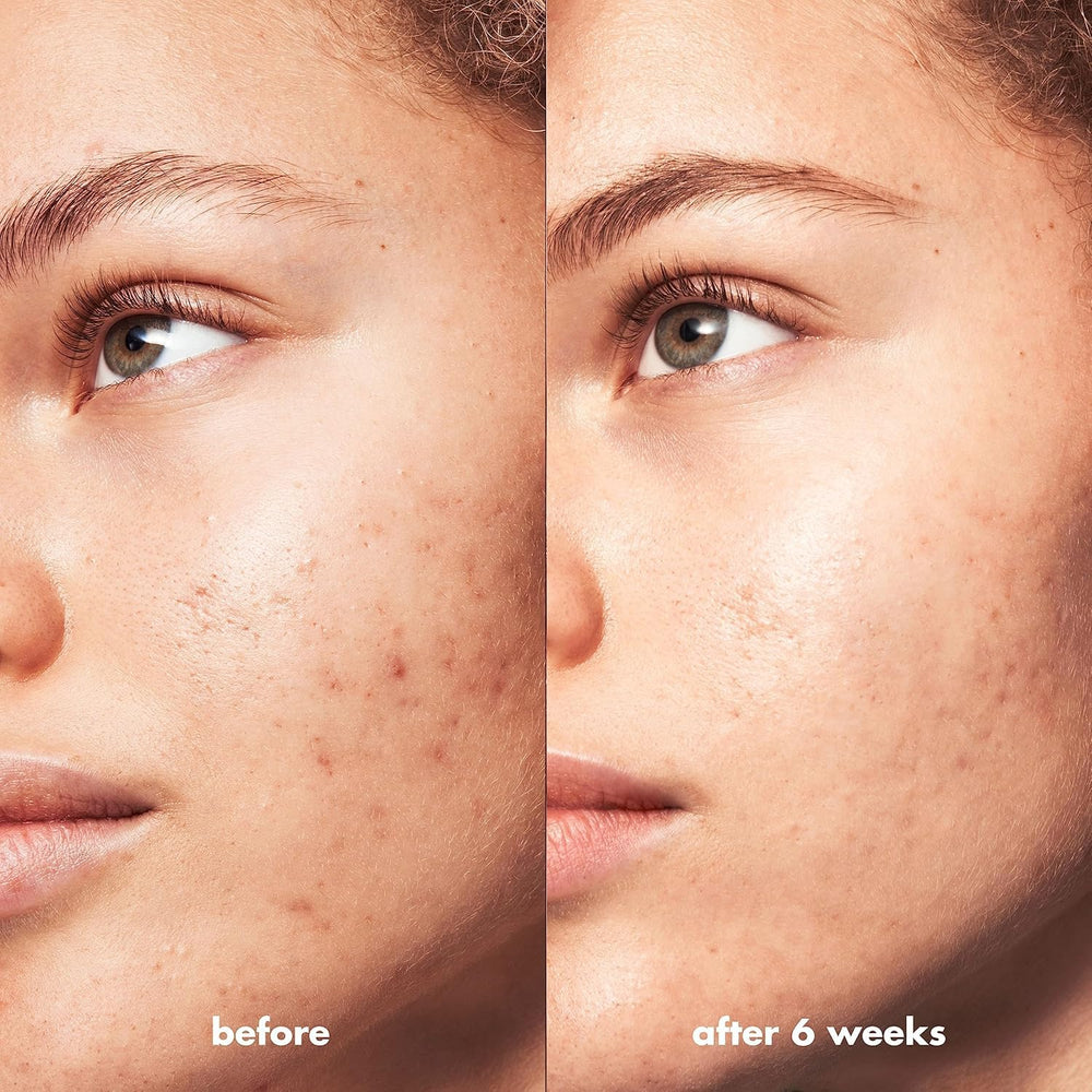 e.l.f. SKIN Blemish Breakthrough: complejo ácido triple.