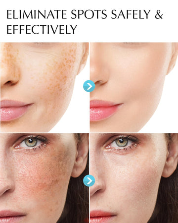EnaSkin Serum iluminador, enfoque en manchas, ayuda a iluminar el rostro de forma suave.