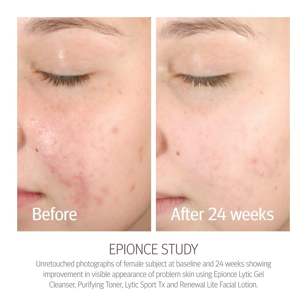 Epionce Renewal Lite Loción Facial: absorción rápida para piel mixta.