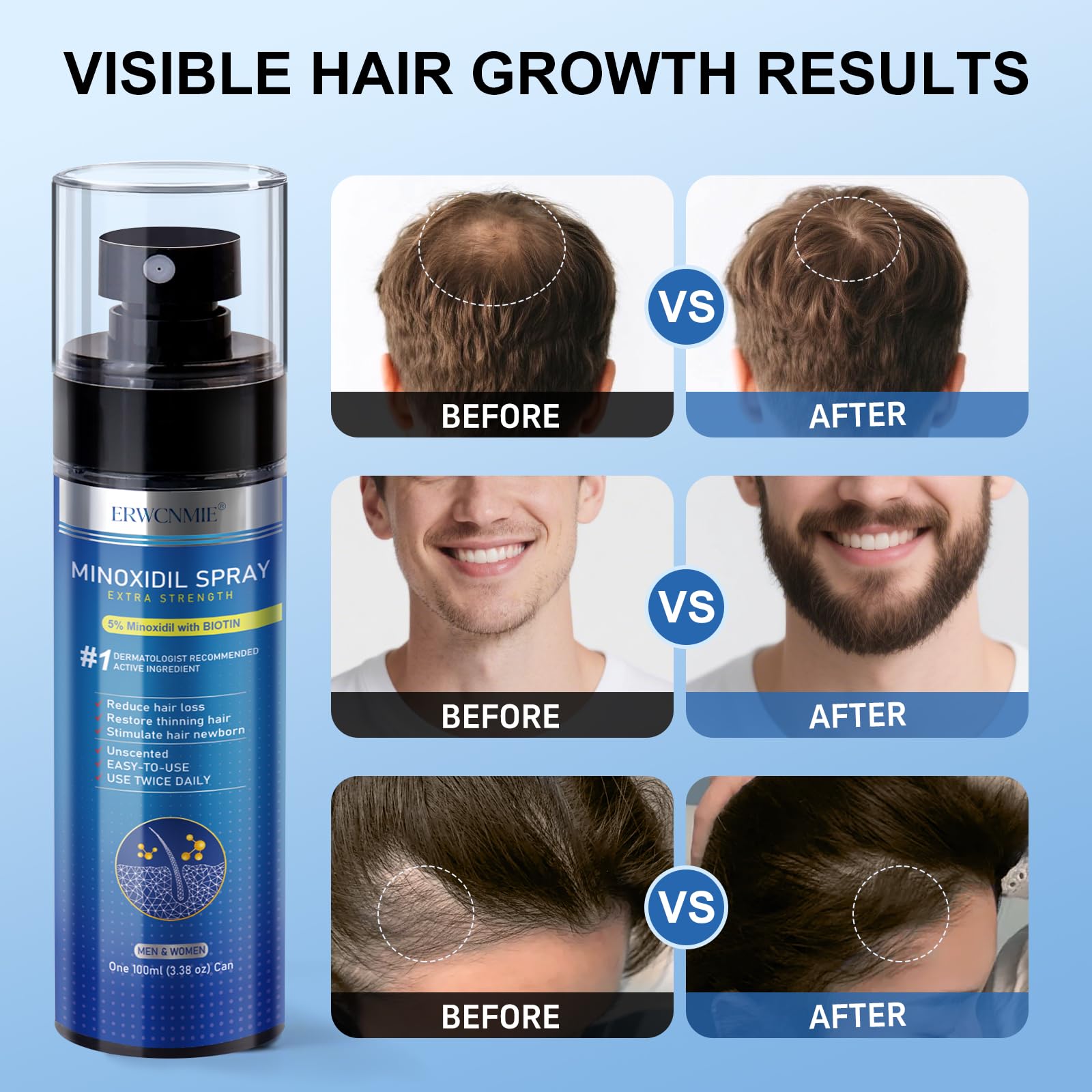 ERWCNMIE Minoxidil Spray aplicación directa al cuero cabelludo para resultados uniformes