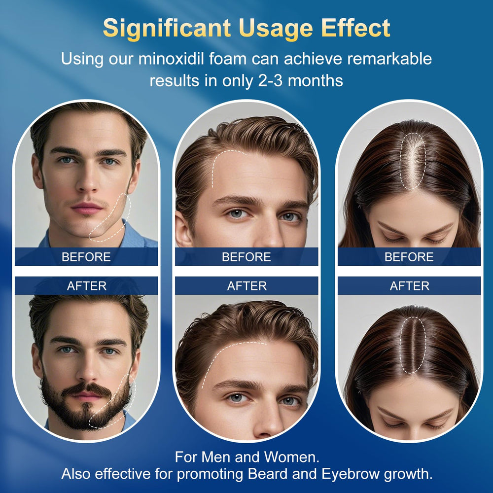 Absorption rapide d'Exdeploy Minoxidil Mousse pour des résultats pratiques