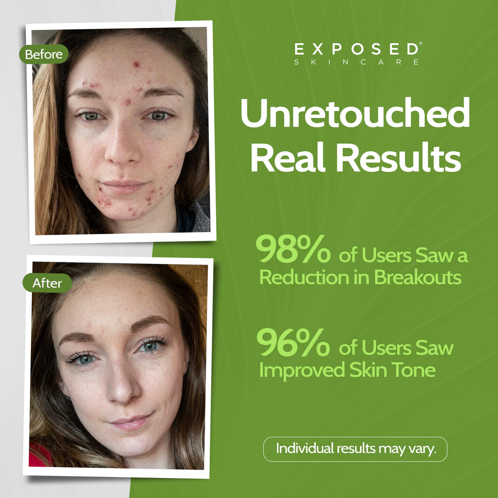 Label close-up highlights 1 percent salicylic acid and natural extracts.