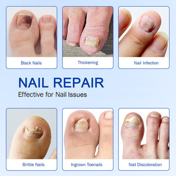 FANSHI patches highlighting reduced discoloration and smoother nail surface.