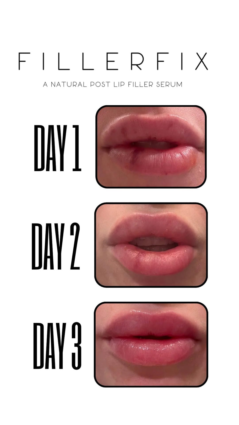 FillerFix cooling ceramic tip in use providing calm, soothing post-procedure relief.