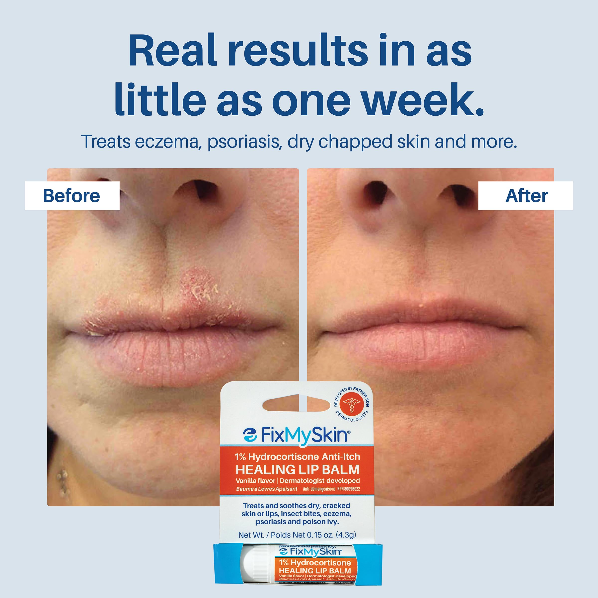 Relaja inflamación leve por herpes labial con bálsamo FixMySkin.