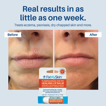 Relaja inflamación leve por herpes labial con bálsamo FixMySkin.