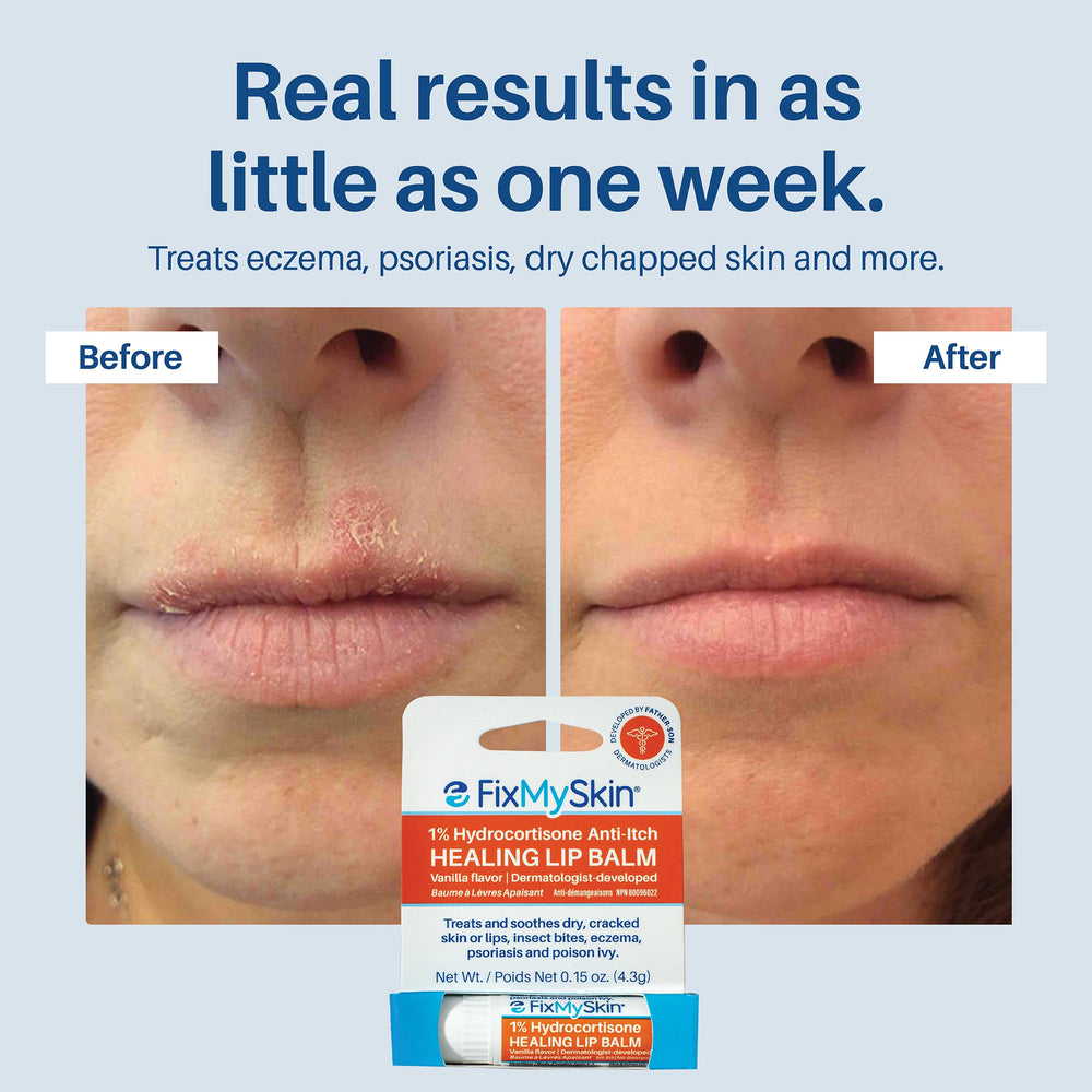 Relaja inflamación leve por herpes labial con bálsamo FixMySkin.