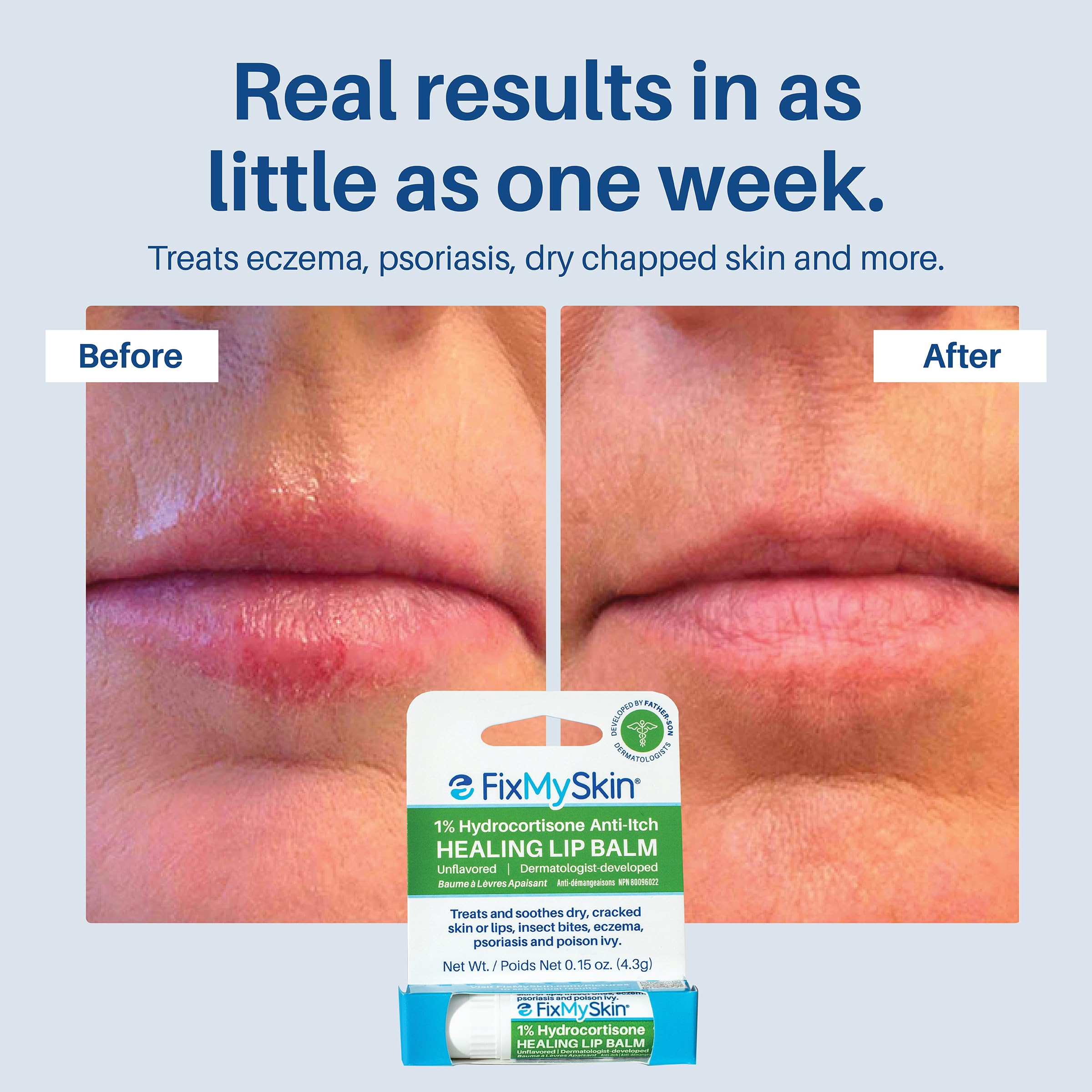 FixMySkin bálsamo labial alivia irritaciones por herpes y eczema.