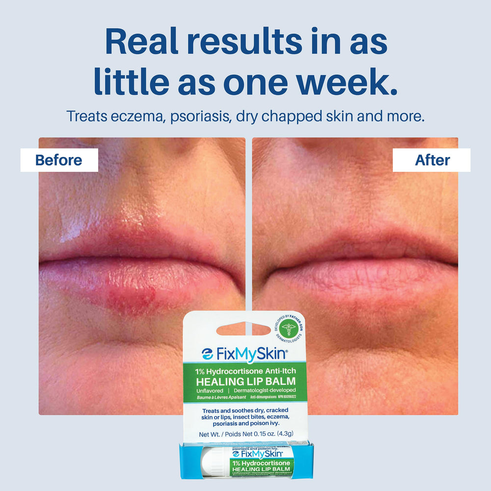 FixMySkin bálsamo labial alivia irritaciones por herpes y eczema.
