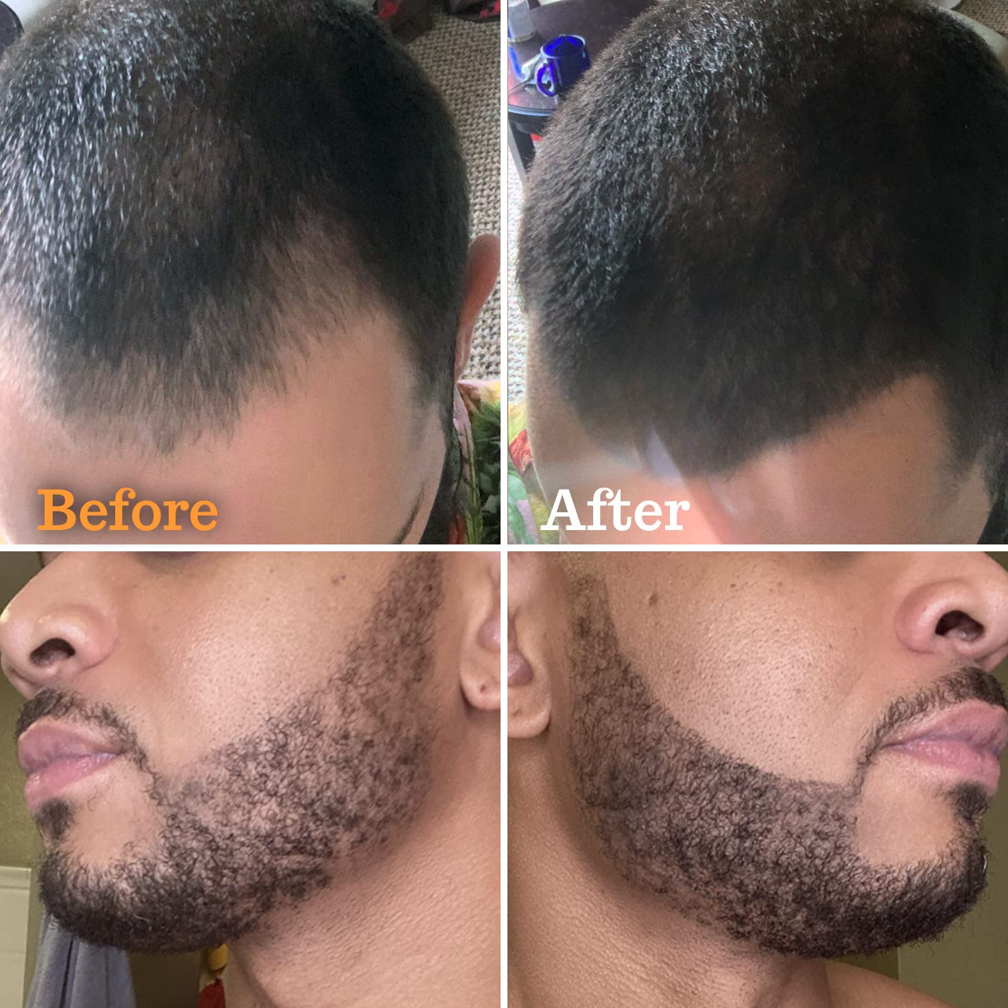 Follicle Booster aplicacion barba natural para cobertura discreta de parches.