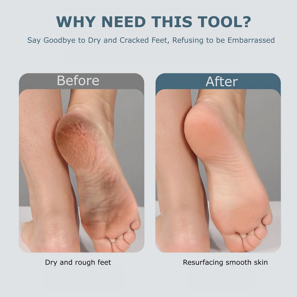 Fooseey exfoliador de pies, diseño-ergonomico para agarre cómodo.