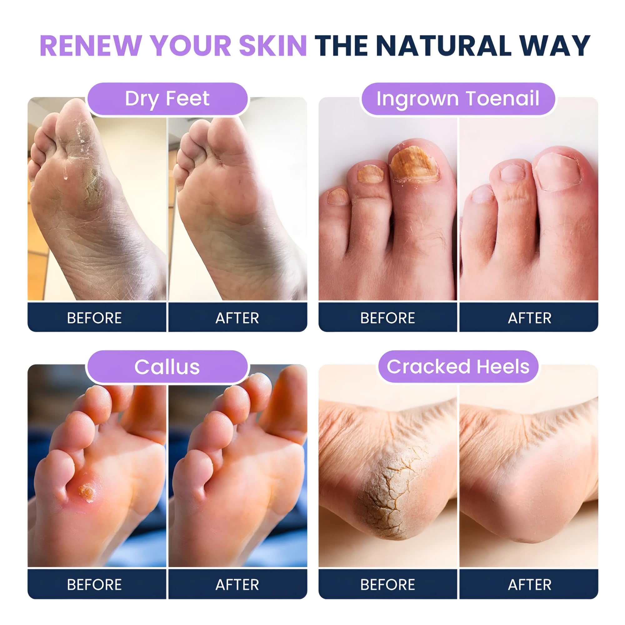 Foot Cure detox-pies aceite-arbol-te para renovacif3n