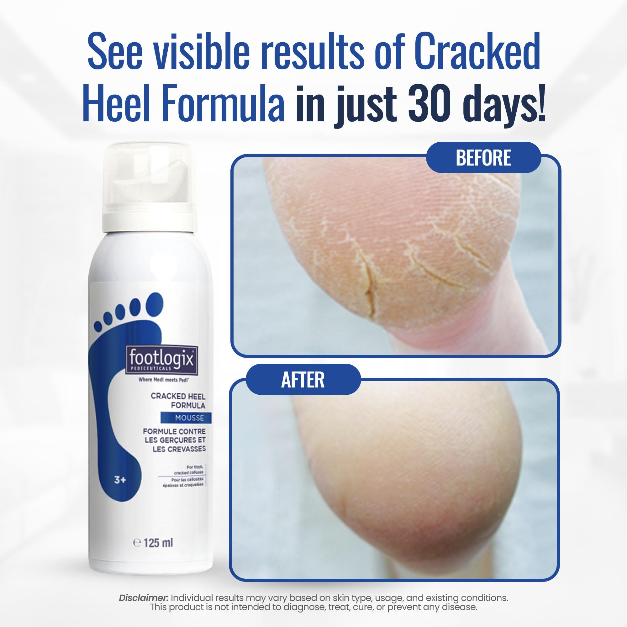 Footlogix aceite de onagra mejora la estructura de la piel de los talones.