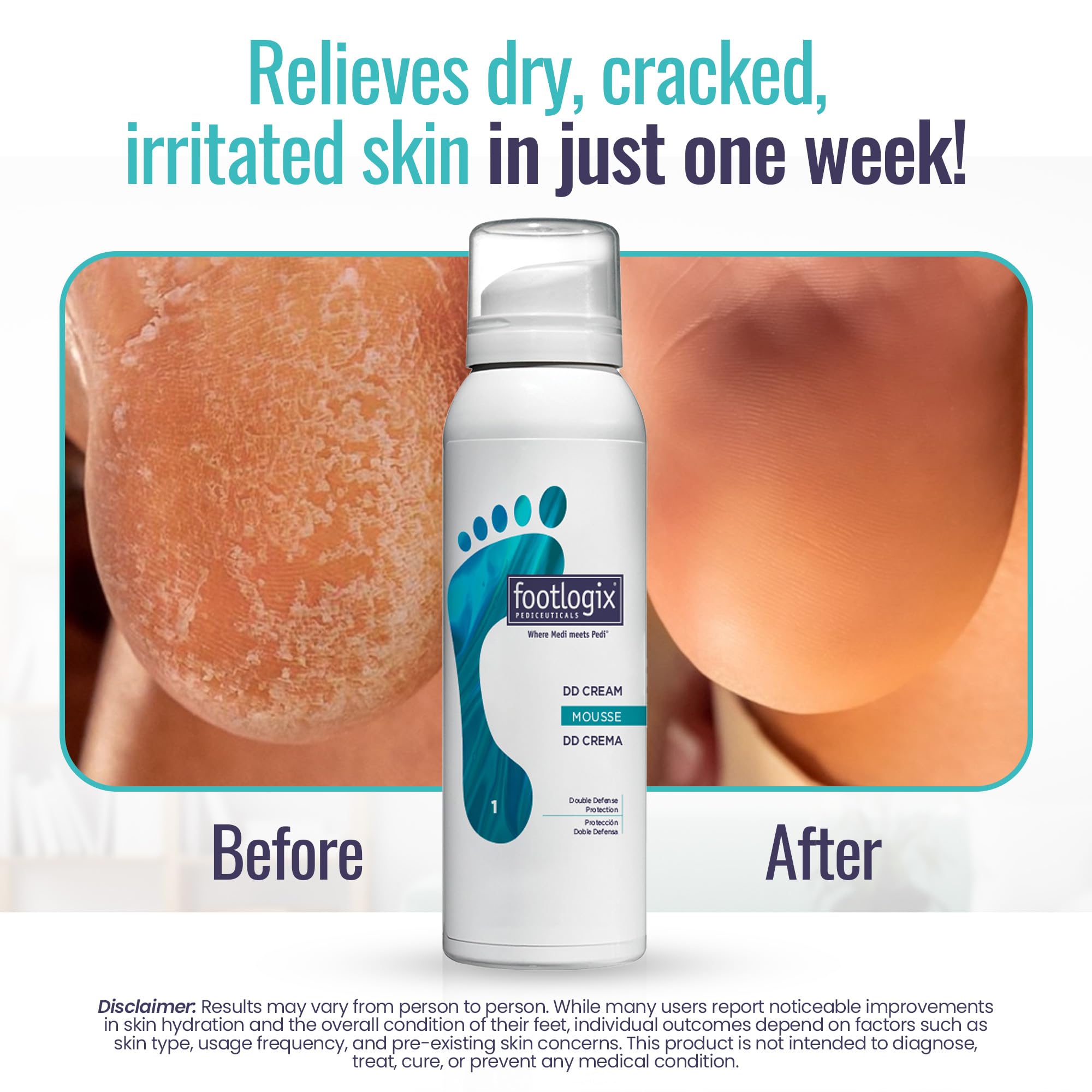 Footlogix DD Cream Mousse con tecnología de infusión dérmica para suavizar la piel de los pies.
