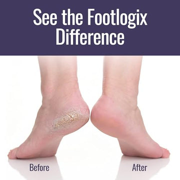 Footlogix talones secos muestra el estado previo al tratamiento