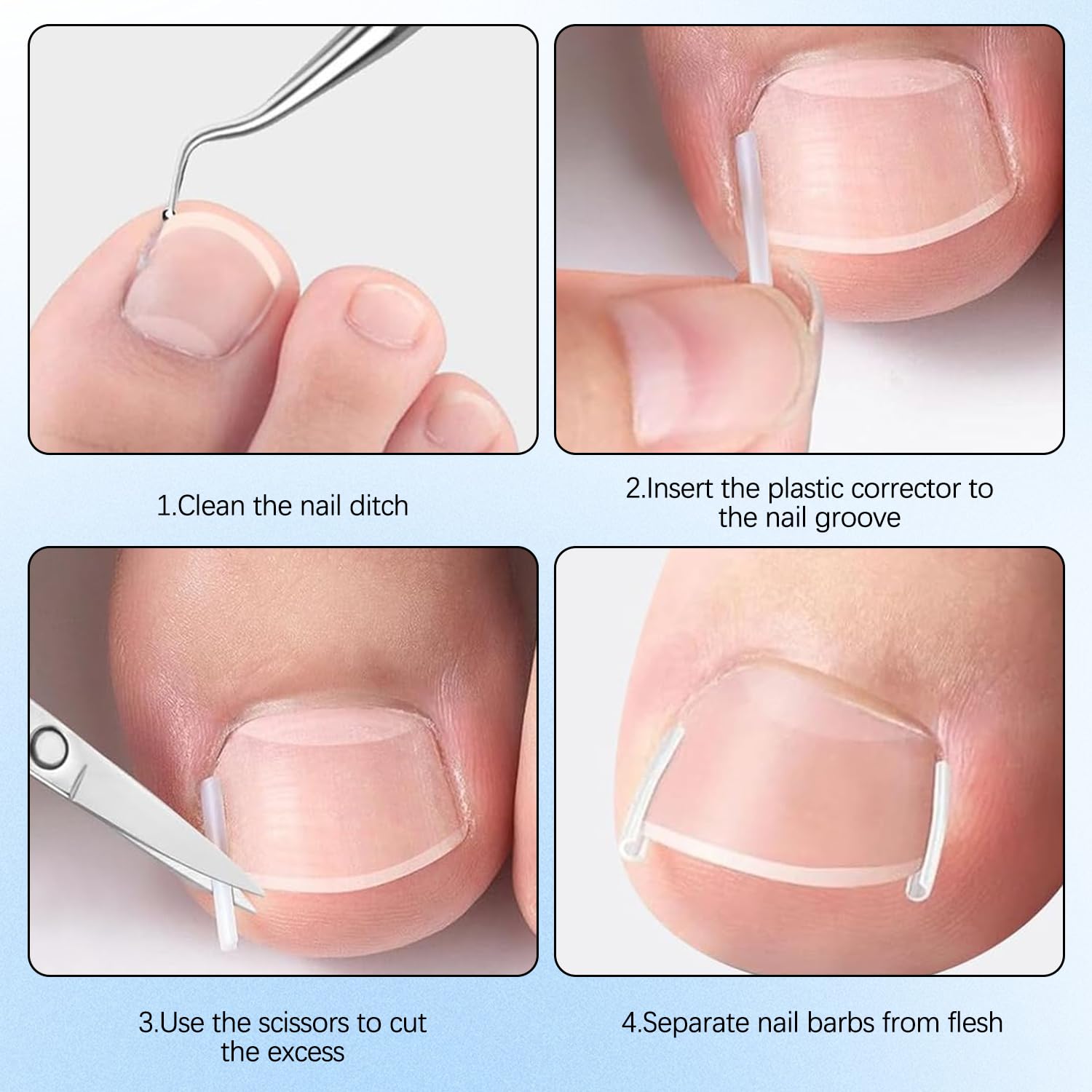 Generic pegatinas gratuitas para corrección de uñas encarnadas