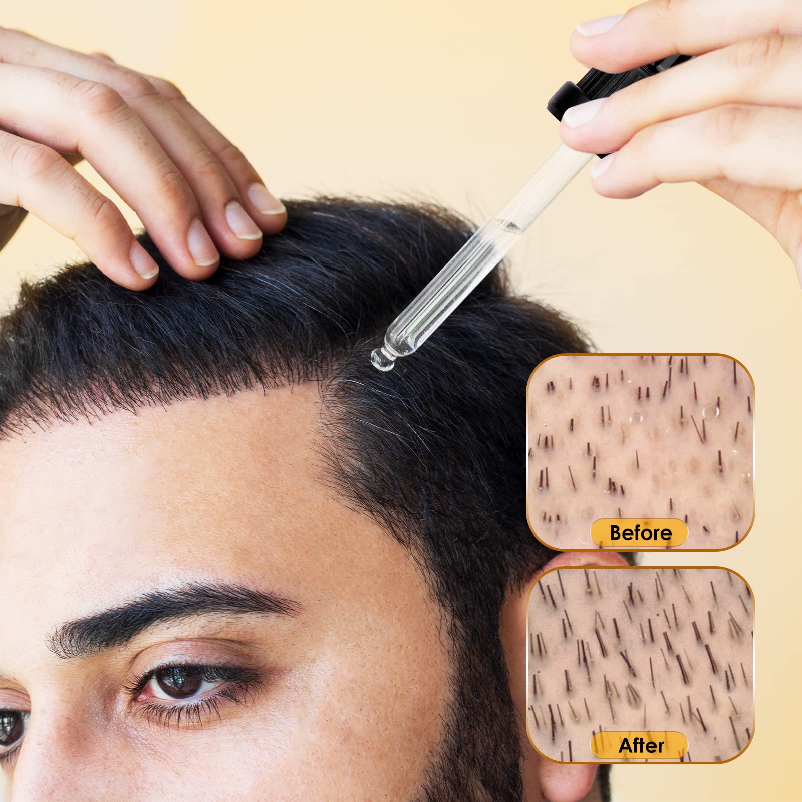 Glemme empaque tubo minoxidil: fácil almacenamiento y uso diario.