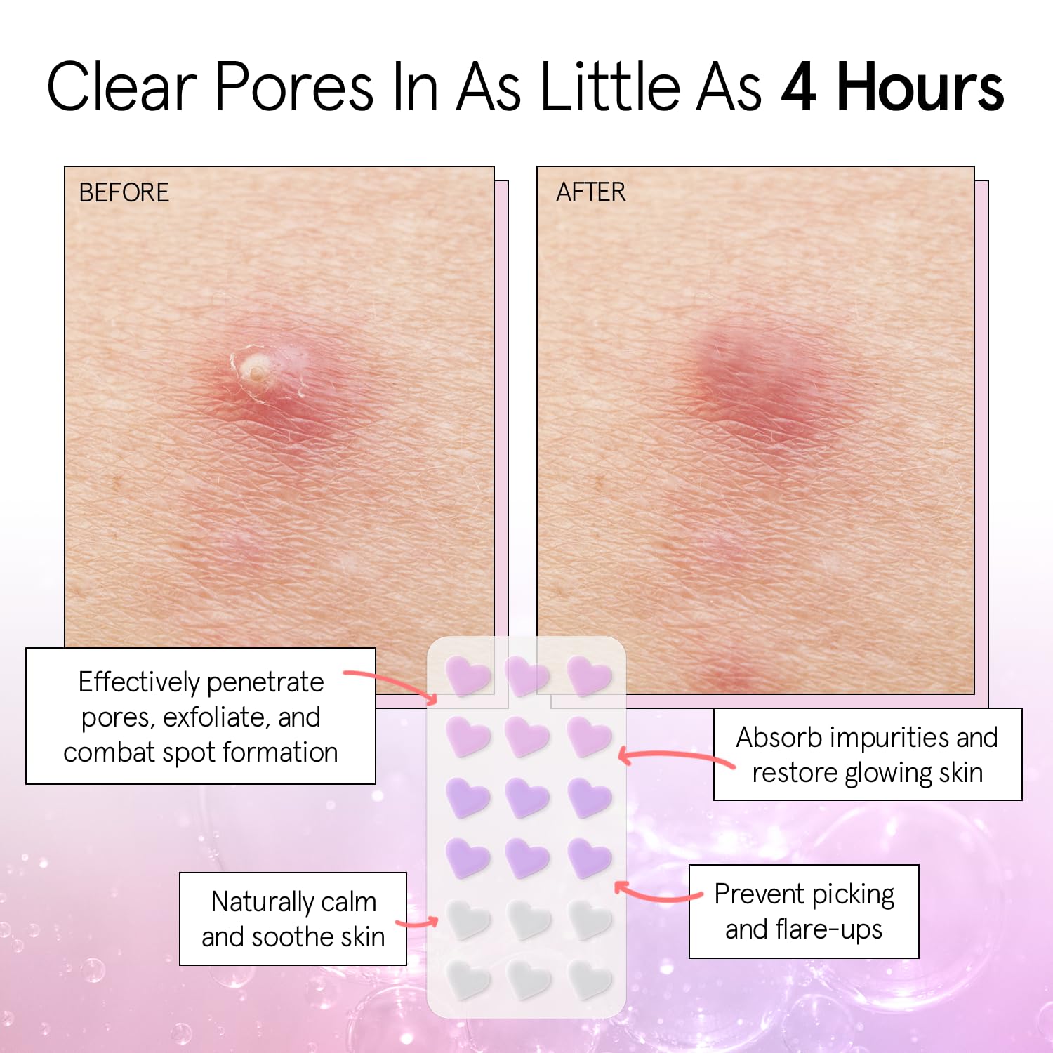 Parche Grace & Stella con corazón violeta disimula imperfecciones discretamente