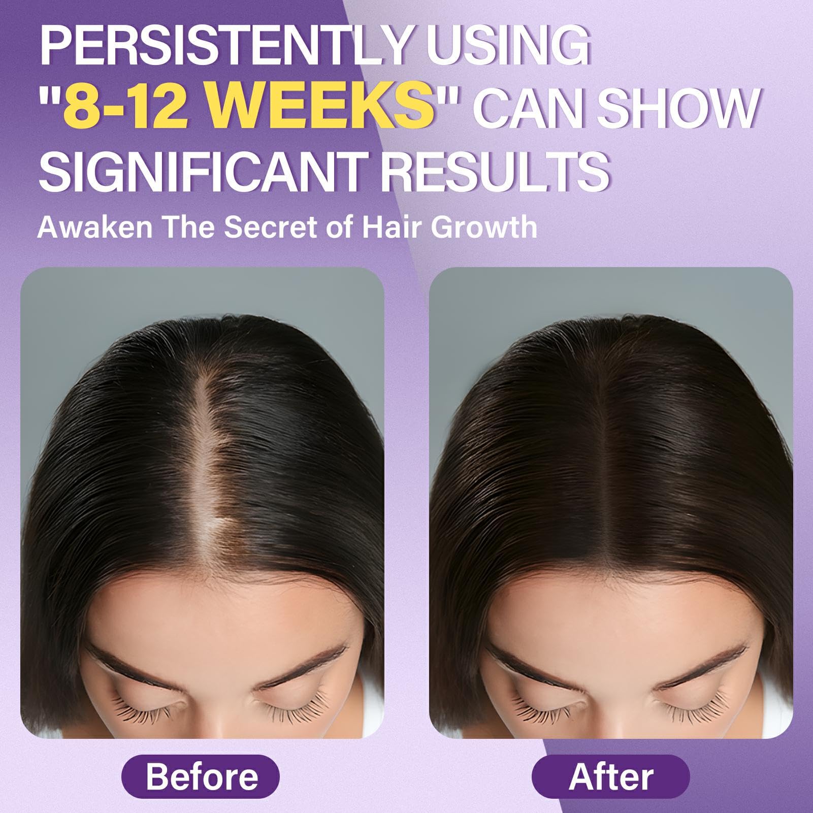 Greoay Minoxidil 5% espuma, aplicación localizada para el cabello.
