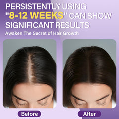 Greoay Minoxidil 5% espuma, aplicación localizada para el cabello.